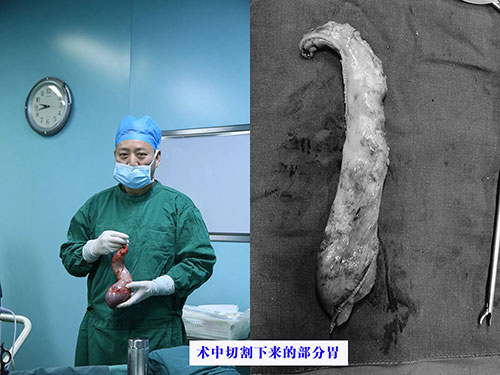 对肥胖大声说NO!——我院开展腹腔镜（微创）下胃部分切除术