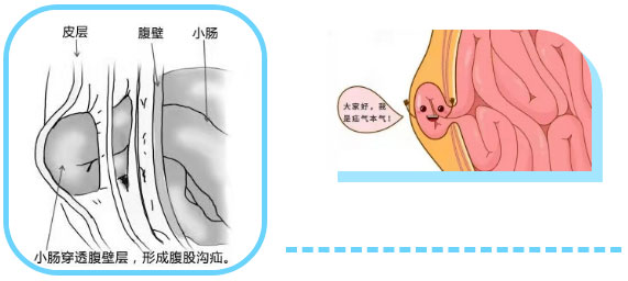 勿以“疝”小而不为：正确认识腹股沟疝