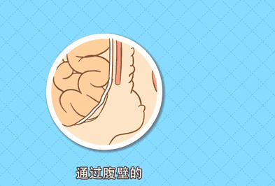 勿以“疝”小而不为：正确认识腹股沟疝