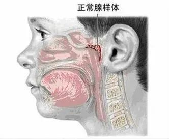 娃睡觉张嘴，打呼噜？警惕腺样体肥大