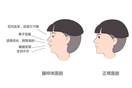 娃睡觉张嘴，打呼噜？警惕腺样体肥大