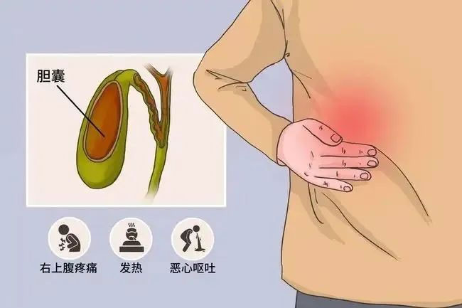 胆囊竟如同一颗松花蛋？这个进展迅速的疾病需警惕！