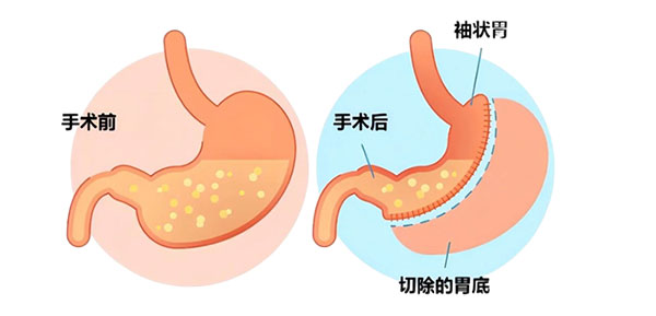 减肥不能“管住嘴”？不妨看看这个“管住胃”的方法