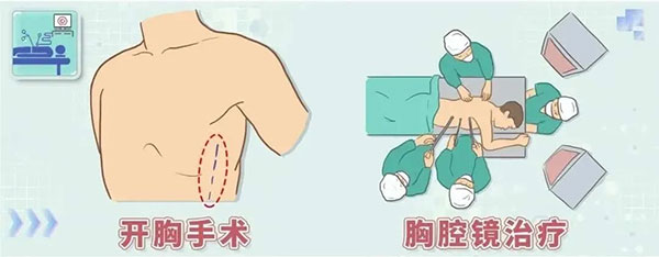 小切口解决大问题！医生带您了解胸腔镜手术......