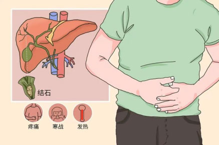 不走寻常路的“石头”——胆总管结石