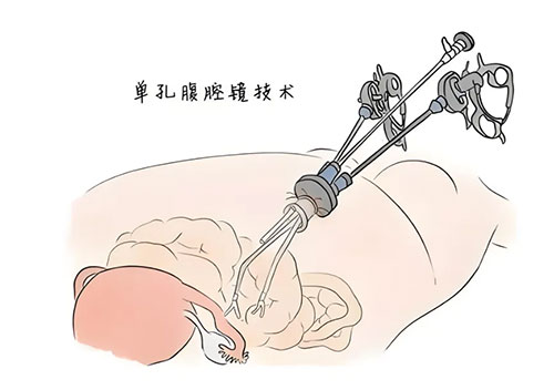 “一孔之术”，让你无压力“炫腹”——单孔腹腔镜手术